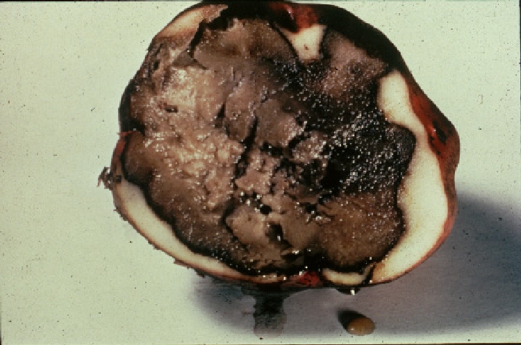 Akıntı Hastalığı 