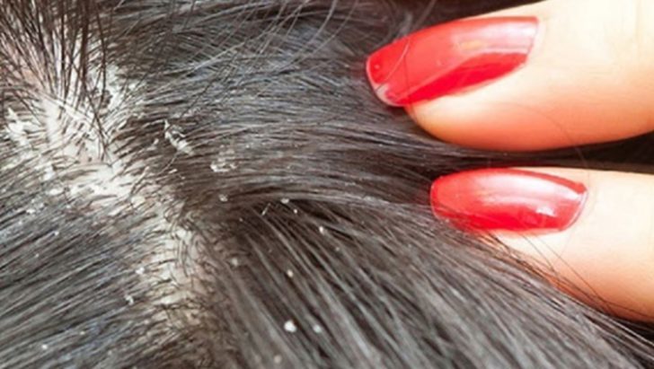 Saç Biti Nedir, Nasıl Bulaşır?