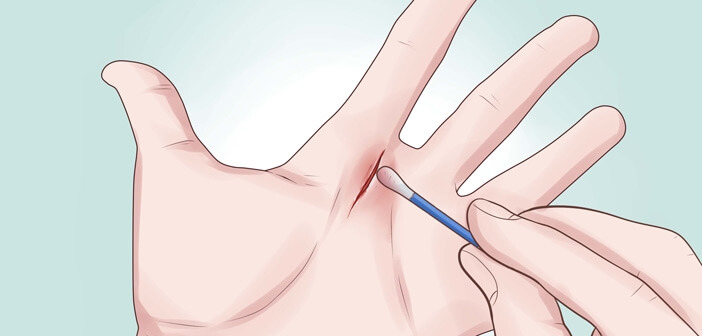 Alkol Yaraya Döküldüğünde Neden Yakar?