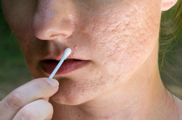 Sivilcelerinizden Kurtulmak İçin Mutlaka Yapın! Sivilcelerinizden Kurtulmak İçin Mutlaka Yapın!