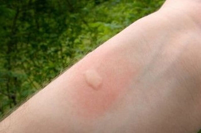 Kolunuzu Sivri Sinek Isırdıysa