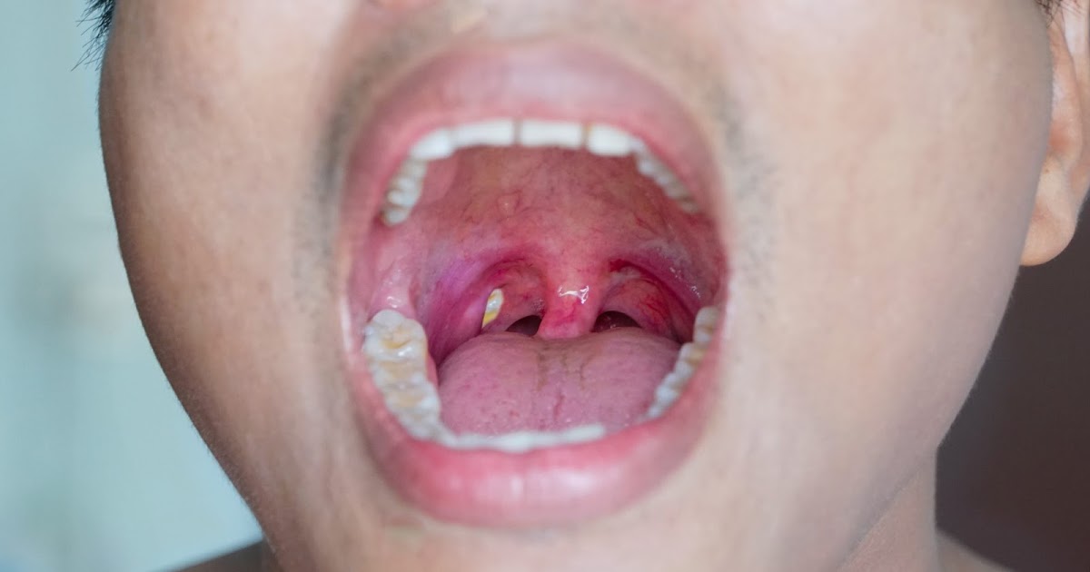 Bademcik İltihaplarında Oluşan Bademcik Taşları Nelerdir?